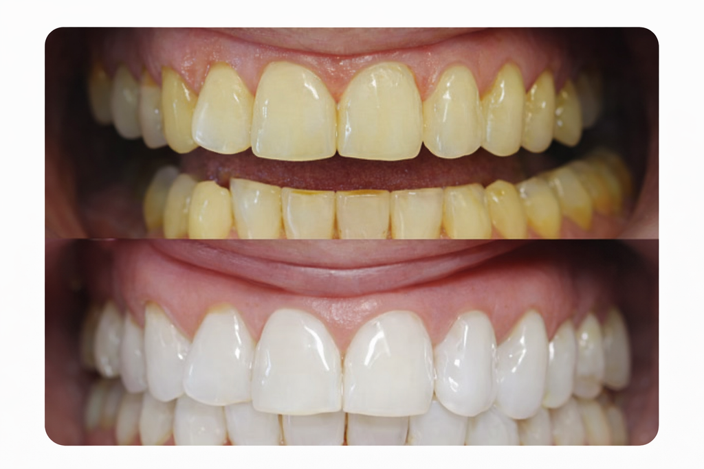 BOLÍGRAFO GEL BLANQUEADOR DENTAL